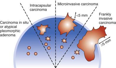 FIG. 7.28, Schematic drawing to show the nomenclature and evolution steps of carcinoma ex pleomorphic adenoma. Deep blue, Pleomorphic adenoma; light blue, fibrous capsule; orange, carcinoma.