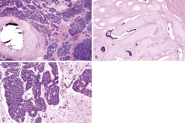 FIG. 7.30, Carcinoma ex pleomorphic adenoma. (A) The right field shows an obvious carcinoma. The left field shows a calcified hyalinized nodule representing the parent pleomorphic adenoma, which might be dismissed as a focus of necrosis or sclerosis. (B) In the hyalinized nodule, tubules of dual cell type with bland cytology can be identified, consistent with pleomorphic adenoma. (C) The carcinoma is an invasive high-grade adenocarcinoma.