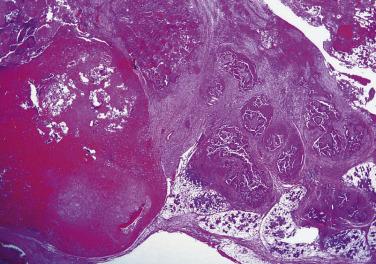 FIG. 7.31, Frankly invasive carcinoma ex pleomorphic adenoma. The circumscribed nodule in the left field represents the parent pleomorphic adenoma. The supervening carcinoma has invaded beyond the confines of the parent tumor, into the surrounding parotid parenchyma. In this example, the tumor has invaded for a distance of 8 mm from the parent tumor.