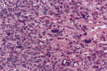 FIG. 7.33, Pleomorphic adenoma. The presence of occasional enlarged hyperchromatic or even bizarre nuclei among bland-looking cells, especially when not accompanied by mitotic figures, does not signify more aggressive behavior.