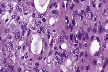 FIG. 7.34, Atypical pleomorphic adenoma. This tumor is worrisome because of generalized nuclear atypia, including prominence of nucleoli. However, because mitotic figures are rare and no invasive growth is present, a designation of atypical pleomorphic adenoma is appropriate.