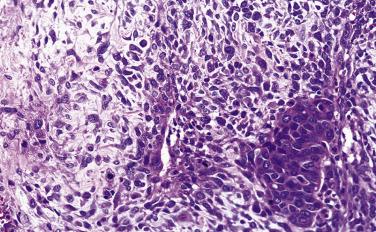 FIG. 7.35, Carcinosarcoma. The carcinomatous component comprises cohesive polygonal cells (right lower field) , and the sarcomatous component comprises loosely dispersed spindle to stellate cells.