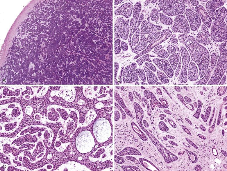 FIG. 7.36, Basal cell adenoma. (A) The tumor is surrounded by a fibrous capsule without evidence of invasion, as is characteristic of adenoma. This shows the prototypic architecture of basal cell adenoma—interconnected jigsaw puzzle–like islands of basaloid cells. (B) Typical jigsaw puzzle–like islands of basaloid cells, interspersed by occasional vacuolar or small cystic spaces. Some true glandular lumens lined by cells with eosinophilic cytoplasm are also seen. In contrast to pleomorphic adenoma, the cell islands are sharply demarcated from the stroma. (C) Anastomosing islands and trabeculae result in a plexiform pattern. (D) Tubules can be present focally or extensively. The dual cell composition is generally best appreciated in the tubular component. This case also shows spindle cells in the stroma in the left field, consistent with myoepithelium-derived stroma.