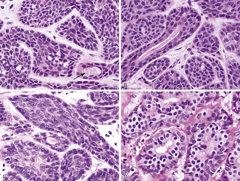 FIG. 7.37, Basal cell adenoma. (A) The tumor islands comprise uniform basaloid cells with focal nuclear palisading at the periphery. The cells have round or oval nuclei that may be grooved. A small ductal structure is indicated by the arrow . (B) Luminal (glandular) cells are often difficult to find in the tumor islands. In the left field, a glandular lumen lined by cells with eosinophilic cytoplasm is present. (C) The nuclei may show streaming along the long axis of the tumor islands. (D) The luminal cells can uncommonly show apocrine change.