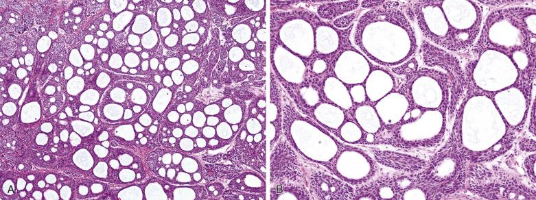 FIG. 7.38, Basal cell adenoma, cribriform variant. (A) This variant may be mistaken for adenoid cystic carcinoma because of the presence of many cribriform structures. (B) Besides absence of invasive tumor borders (not shown), the cribriform islands appear to be formed by expanded jigsaw puzzle–like lobules punctuated by multiple cystic spaces, and they merge with the characteristic basaloid lobules of basal cell adenoma (lower field) .