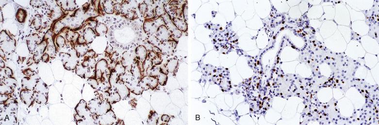 FIG. 7.4, Normal salivary gland immunostained for myoepithelial or basal cell markers. (A) Calponin is expressed in myoepithelial cells (the cell processes of which wrap around the acini and intercalated ducts), but not in the basal cells that surround the striated ducts. (B) p63 is expressed in the nuclei of both myoepithelial and basal cells that surround the secretory-ductal units.