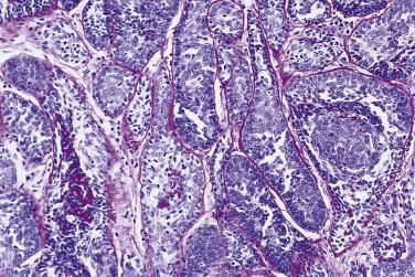 FIG. 7.41, Basal cell adenoma, membranous type. Periodic acid–Schiff–diastase stain dramatically highlights the thick hyaline sheaths around the tumor islands, as well as the interposed hyaline material among the tumor cells.