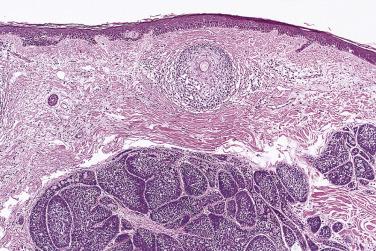 FIG. 7.42, Synchronous dermal cylindroma in a patient with membranous basal cell adenoma. Note the remarkable identity of histologic appearances of the two tumor types, which explains the alternative name of dermal analogue tumor for membranous basal cell adenoma.