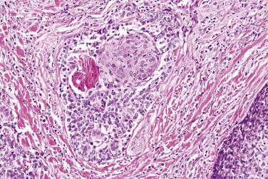 FIG. 7.45, Basal cell adenocarcinoma. The central portion of the tumor island shows squamous differentiation with keratinization.