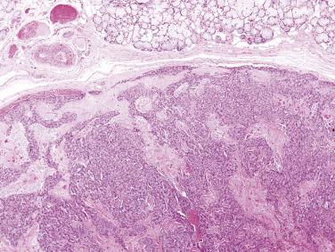 FIG. 7.47, Myoepithelioma. The tumor is surrounded by a thin fibrous capsule. This example shows a monotonous tumor cell population.