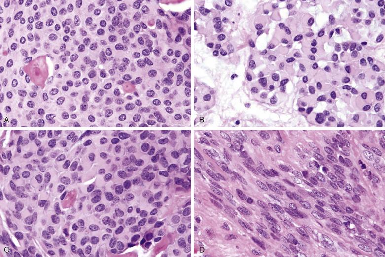 FIG. 7.49, Myoepithelioma: cytologic features. (A) Oval or polygonal cells with uniform nuclei and eosinophilic cytoplasm. (B) Plasmacytoid hyaline cells. (C) Plasmacytoid hyaline cells (left field) and semiplasmacytoid hyaline cells (right field) . (D) Plump spindle cells with eosinophilic cytoplasm.