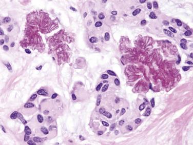 FIG. 7.50, Myoepithelioma. Tyrosine crystals (resembling daisy heads) are present in the stroma of this case.