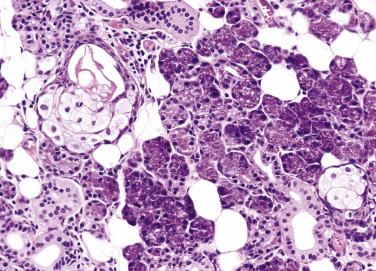 FIG. 7.5, The normal parotid gland. If it is sampled extensively, rare groups of sebaceous cells may be seen among the serous acini and striated ducts. Note also the typical abundance of adipose cells in the parotid gland.