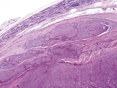 FIG. 7.51, Myoepithelial carcinoma. This tumor infiltrates in broad fronts into the salivary parenchyma (upper field) . The invasion identifies this as a malignant neoplasm.