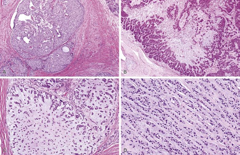 FIG. 7.52, Myoepithelial carcinoma: growth patterns. (A) Large islands and sheets separated by sclerotic stroma. (B) Large tumor island with festooning pattern in the peripheral portion and geographic myxohyaline material in the center. (C) Tumor cell cords and single cells suspended in a myxohyaline matrix. (D) Trabecular growth pattern.