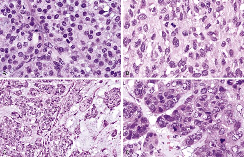 FIG. 7.53, Myoepithelial carcinoma: cytologic features. (A) This example is composed of sheets of bland-looking polygonal cells with eosinophilic cytoplasm, and the diagnosis of malignancy is based on the presence of unequivocal invasive growth. (B) This example shows mild cellular atypia and mitotic activity. As characteristic of myoepithelial neoplasms, the cytoplasm is eosinophilic. (C) Tumor cells with moderate cellular atypia are disposed in a trabecular-festooning pattern and accompanied by myxoid matrix. (D) This example shows overt nuclear pleomorphism and many mitotic figures.