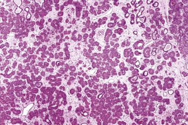 FIG. 7.55, Diffuse oncocytosis of the submandibular gland. Extensive oncocytic metaplasia of the ductal cells is present, accompanied by loss of acinar units. Note the preservation of lobular architecture.