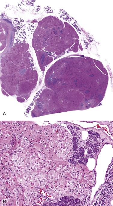 FIG. 7.56, Nodular oncocytic hyperplasia. (A) The multiple pink-staining nonencapsulated nodules are formed by expansion of preexisting salivary lobules. (B) The packets of oncocytic cells merge closely in the peripheral portion with residual secretory acini.