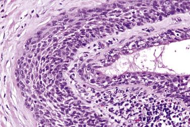 FIG. 7.58, Oncocytoma complicated by infarction. In the surviving islands of tumor, squamous metaplasia is present. The cellular atypia can lure one to an erroneous diagnosis of squamous cell carcinoma.