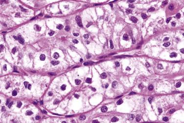 FIG. 7.59, Clear cell oncocytoma. As in the ordinary oncocytoma, polygonal cells are arranged in compact trabeculae separated by a delicate vasculature. Most cells in this field show cytoplasmic clearing, while retaining sparse granularity.