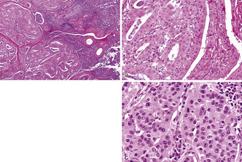 FIG. 7.60, Oncocytic carcinoma. (A) The invasive growth distinguishes this tumor from an oncocytoma. (B) The oncocytic tumor cells show mild nuclear atypia, and thus the diagnosis of malignancy in this example rests on the identification of invasion. (C) The oncocytic tumor cells exhibit overt nuclear atypia and mitotic activity, and thus the diagnosis of carcinoma is straightforward in this case.