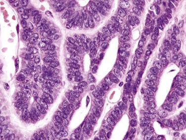 FIG. 7.62, Canalicular adenoma. The lining cells are bland-looking columnar ductal cells. Myoepithelial cells are absent.