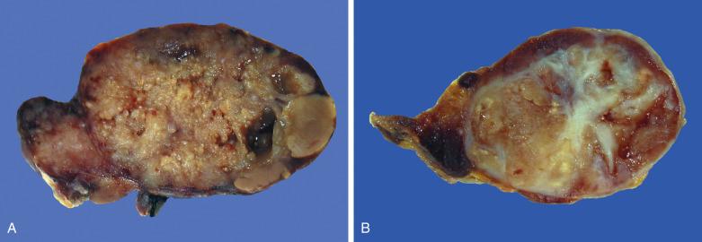 FIG. 7.63, Warthin tumor, gross appearance. (A) The cut surface shows a well-encapsulated tumor with some cysts and brown solid areas exhibiting a granular texture. (B) This example shows prominent fibrosis, attributable to repair after prior fine-needle aspiration.