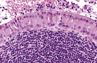 FIG. 7.65, Warthin tumor. The papillae and glands are typically lined by columnar oncocytic luminal cells in which the nuclei are often polarized toward the lumen. Beneath the luminal cells is a layer of basal cells, which are sharply demarcated from the underlying lymphoid stroma.