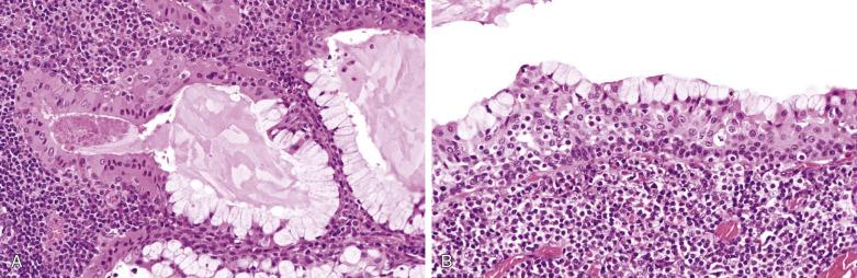 FIG. 7.66, Warthin tumor with metaplastic epithelium. (A) Abrupt transition from oncocytic epithelium (left) to mucinous epithelium (right) is seen. (B) Metaplasia of oncocytic epithelium to mucinous and squamoid cells results in mimicry of mucoepidermoid carcinoma.