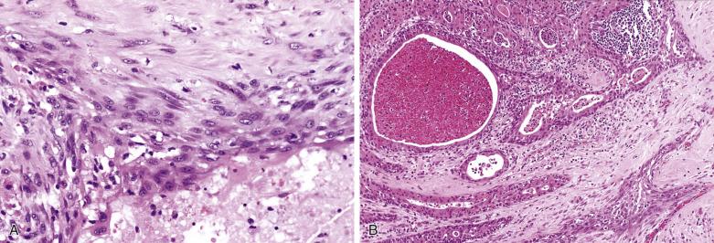 FIG. 7.67, Warthin tumor complicated by infarction and squamous metaplasia. (A) The residual neoplastic epithelium has undergone squamous metaplasia. The presence of cytologic atypia may lead to an erroneous diagnosis of squamous cell or mucoepidermoid carcinoma. (B) Identification of continuity of the squamous epithelium with residual oncocytic epithelium (left field) establishes the metaplastic nature of the squamous proliferation.