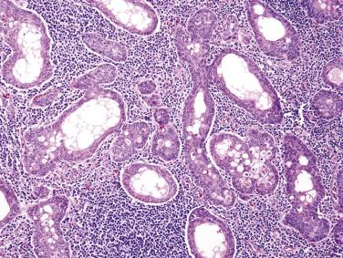 FIG. 7.68, Sebaceous lymphadenoma. In the epithelial islands disposed in a lymphoid background, basaloid cells are located peripherally, whereas sebaceous cells are located centrally, sometimes with formation of central cystic spaces.