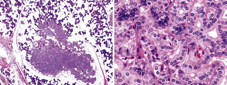 FIG. 7.8, Intercalated duct lesion (hyperplasia). (A) In the parotid parenchyma, a noncircumscribed lesion comprising closely packed small ducts is seen. (B) The ducts are lined by cuboidal cells with uniform nuclei and eosinophilic cytoplasm. In the peripheral portion (upper field) , some cells contain basophilic zymogen granules.