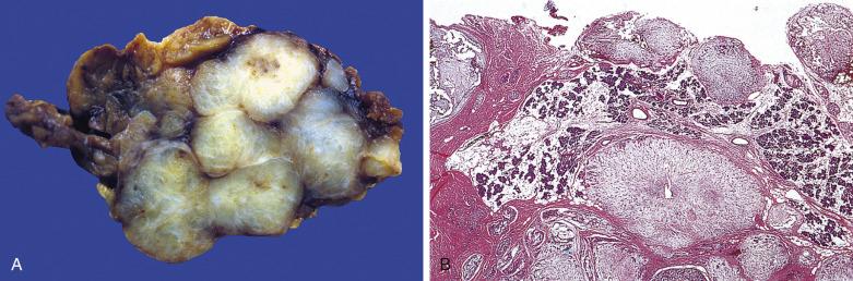 FIG. 7.9, Recurrent pleomorphic adenoma of the parotid gland. Note the typical multinodular growth pattern. Very frequently, as in this case, the tumor is predominantly myxoid. (A) Gross specimen. (B) Corresponding histologic appearance.