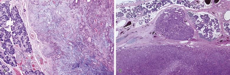 FIG. 7.10, Low-magnification appearance of pleomorphic adenoma. (A) The tumor is typically well circumscribed. It often shows variegated growth patterns, with alternating cellular and myxoid areas. (B) Small satellite nodule is present immediately outside the thin capsule of the tumor. This represents a tumor protuberance in which the site of capsular penetration is not evident in this plane of sectioning. This finding is still compatible with a diagnosis of benign pleomorphic adenoma.