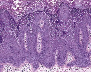 FIG. 23.1, Verruca vulgaris. Papillomatous lesion exophytic-endophytic growth pattern.