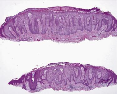 FIG. 23.13, Pale (clear) cell acanthoma. Exophytic lesion of pale keratinocytes containing abundant glycogen.