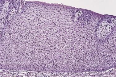 FIG. 23.14, Pale (clear) cell acanthoma. Higher power, emphasizing the clear (pale) keratinocytes.