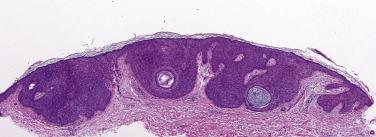 FIG. 23.15, Seborrheic keratosis, reticular type. Exophytic keratinous lesion.