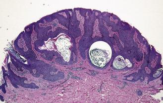 FIG. 23.16, Seborrheic keratosis. Uniform keratinocytes with horn and pseudohorn cysts.