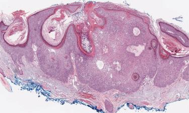 FIG. 23.17, Inverted follicular keratosis (inverted seborrheic keratosis). The lesion grows downward and is filled with small squamous eddies.