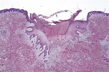 FIG. 23.18, Pseudocarcinomatous hyperplasia. Vertically oriented, bulbous thickenings of squamous epithelium in the superficial dermis associated with granulation tissue.