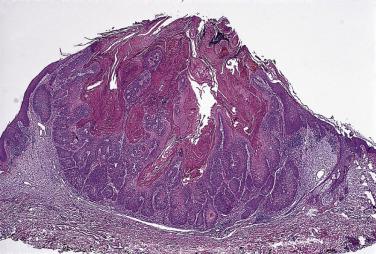 FIG. 23.19, Keratocanthoma. Cup-shaped, symmetric lesion with central keratin crater.