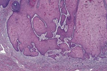 FIG. 23.20, Keratocanthoma. These glassy squamous lobules usually contain apoptotic keratinocytes.