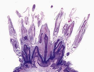 FIG. 23.2, Verruca vulgaris. Pronounced exophytic filiform papillations.