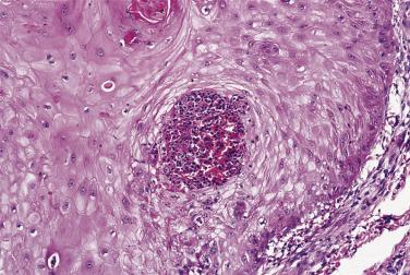 FIG. 23.21, Keratocanthoma. Microabscesses are common at the advancing edge of these lesions.