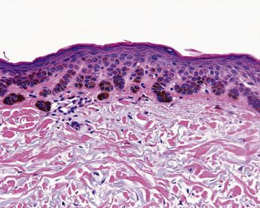 FIG. 23.22, Solar lentigo. Club-shaped epidermal hyperpigmentation on actinically affected skin.