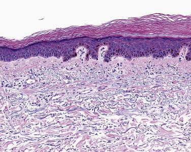 FIG. 23.23, Large cell acanthoma. Right half of the skin is thicker and contains keratinocytes approximately twice the normal size. The overlaying keratin is orthokeratotic.