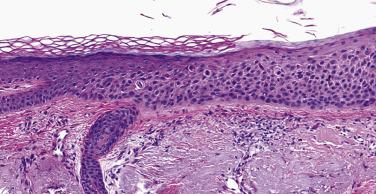 FIG. 23.24, Actinic keratosis. Squamous cell atypia and overlying parakeratosis in the context of solar elastosis.