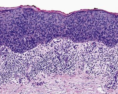 FIG. 23.27, Squamous carcinoma in situ (Bowen disease). Full-thickness epidermal atypia, usually in sun-protected areas.