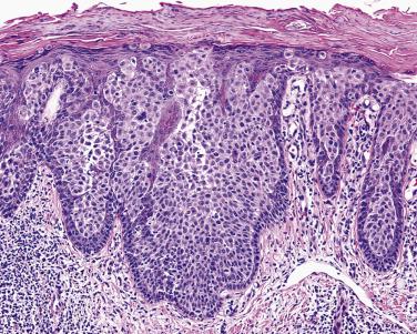 FIG. 23.28, Bowen disease, clonal. The clones of immature keratinocytes can be confused with ductal lesions.